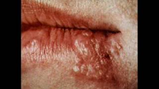 Cold Sore Information and Treatment [upl. by Eigla]