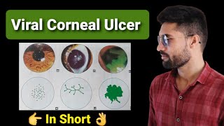 Viral corneal ulcer lecture opthalmology [upl. by Yoccm727]