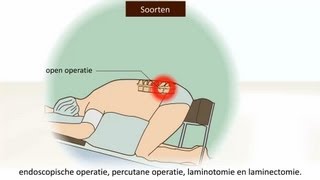 Herniaoperatie  Welke soort is het meest effectief [upl. by Eichman425]