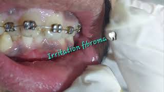 Oral benign asymptomatic prolonged irritation fibroma caused by cheek biting rubbing from teeth [upl. by Hirsh480]