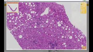 Approach to Liver Biopsy with Keith Kaplan MD [upl. by Erdnoid582]