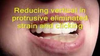 TMJ click with NTI and its resolution [upl. by Varney]