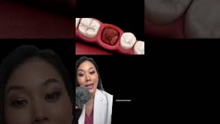 How to avoid dry socket after wisdom tooth extraction wisdomtooth wisdomteeth drysocket tooth [upl. by Ody]