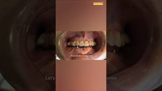 DentalImplants dentist zenithclinic missingteeth frontteeth brokentoothrepair fixedteeth [upl. by Norra]