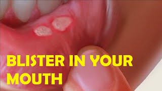 how to get rid of a blister in your mouth quickly [upl. by Niwle756]