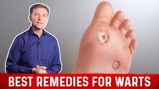 4 Best Wart Removal Remedies – Dr Berg on Wart Treatment at Home [upl. by Morley937]