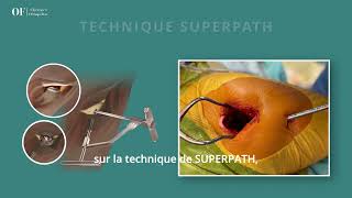 Prothèse totale de hanche par technique mini invasive Superpath présentation par le Dr OFontes [upl. by Enimrac]