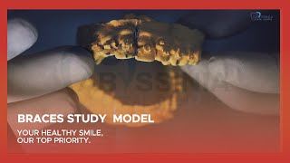 Orthodontic Study Model Understanding Treatment Progress [upl. by Terrill]