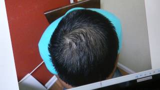 Men Hair Loss Crown Vertex Transplant Surgery Result Bay Area California 1 Yr wwwmhtacliniccom [upl. by Myrwyn]