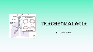 Tracheomalacia  clinical features investigation treatment and management [upl. by Ethelind827]