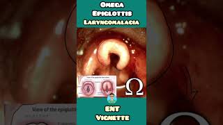 Omega Epiglottis in Laryngomalacia made easy for USMLE NEET PG INCET NCLEX [upl. by Enomar130]