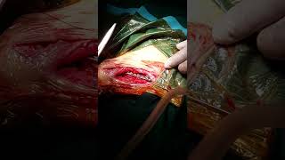 Canine Humeral fracture repair 5 [upl. by Neliac121]