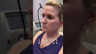 Natural Results  Mini Facelift with Neck Lift  Before amp After [upl. by Nosrac]