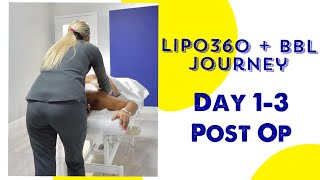 Maximizing Recovery Lymphatic Massages After Liposuction amp BBL [upl. by Lundquist]