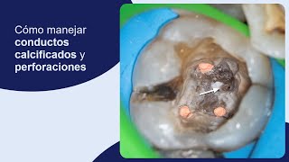 Cómo manejar conductos calcificados y perforaciones [upl. by Yhtuv429]