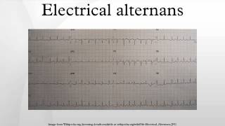 Electrical alternans [upl. by Htims]