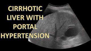 CIRRHOTIC LIVER WITH PORTAL HYPERTENSION ON ULTRASOUND  WITH PRACTICAL TIP [upl. by Korman]