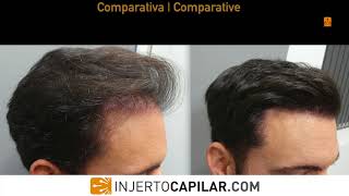 2009 FUE Grafts Repair case Temporal peaks Early regrowth at 5 m 20092017 [upl. by Llertnod]