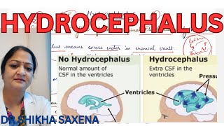 Hydrocephalus high CSF pressure communicating and noncommunicating Hydrocephalus [upl. by Bartolomeo]