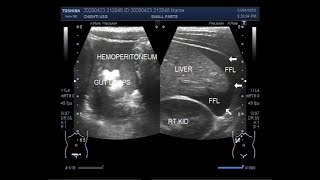 Ultrasound Video showing Hemoperitoneum with fluid in Morisons pouch or Hepatorenal recess [upl. by Heinrich]