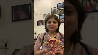 fibroid fibroidsymptoms fibroiduterus fibroidsawareness frequenturine  English  Dr neera bhan [upl. by Ainyt380]