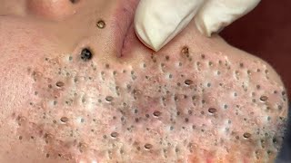 Big Cystic Acne Blackheads Extraction Blackheads amp Milia Whiteheads Removal Pimple Popping  5109 [upl. by Anitnemelc]