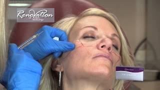 Introducing JUVÉDERM VOLUMA™ XC in Nevada at Renovation Medical Spa [upl. by Lorak]