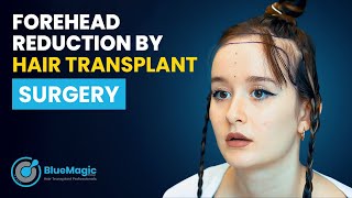 Forehead Reduction by Hair Transplant Surgery  BlueMagic Group Clinic [upl. by Vivian]