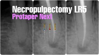 Root canal treatment lower right second premolar 45 protaper next [upl. by Nisse667]