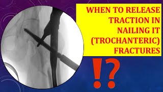 Traction release in trochanteric IT fracture nailining WHEN amp HOW MUCH [upl. by Eylrahc]