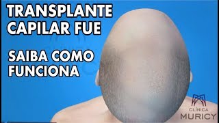 TRANSPLANTE CAPILAR FUE  SAIBA COMO FUNCIONA [upl. by Derrek]