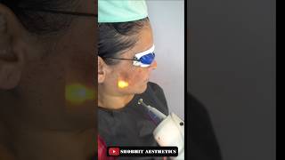 Laser Treatment At Shobhit Aesthetics [upl. by Notsniw]