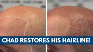 Chads Story ⇒ Before amp After Scalp Micropigmentation Hair Loss Solution [upl. by Viglione337]