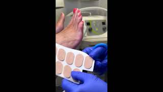 5th toe corn pad and debridement  short debridement toecornpad [upl. by Attenreb]