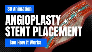 How Angioplasty and Stent Placement Works  3D Animation [upl. by Niraj]