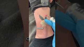 Tattoo Removal hwclinicbrugge [upl. by Onileba]