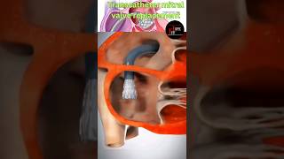 3D Transcatheter mitral valve replacement😱😲💯 demonstration heart health 3d shorts [upl. by Llerej]