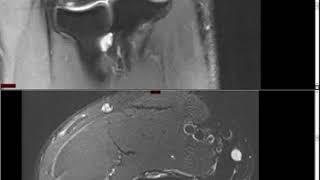 Elbow MRI Approach to MSK MRI Series [upl. by Ali297]