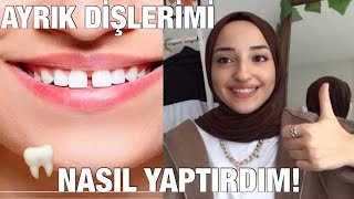 ÜCRETSİZ ŞEKİLDE AYRIK DİŞLERİMİ NASIL YAPTIRDIM  BONDİNG İŞLEMİ🦷 [upl. by Anikehs32]