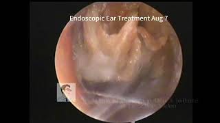 Similarities between cholesteatoma and cerumen embolism 20230807 [upl. by Lleral]