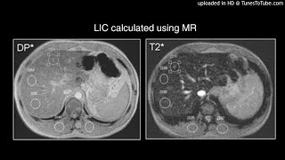 Cardiac and Hepatic Hemosiderosis as Measured by T2MRI [upl. by Cloots]