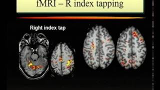 Multiple Sclerosis [upl. by Aitsirt]