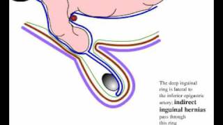 Direct and indirect inguinal hernia [upl. by Erle]