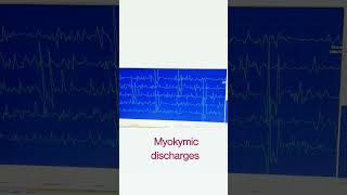 Myokymic discharges emg sounds like MARCHING SOLDIERS [upl. by Einnus398]