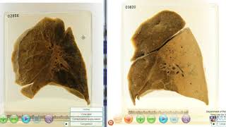 Lobar pneumonia vs Bronchopneumonia [upl. by Anoyi320]