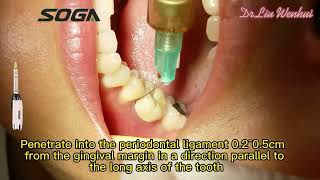 DrLiuwenhui——periodontal ligament injection [upl. by Dimo]