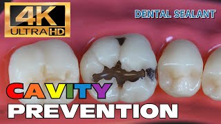 HOW TO PREVENT CAVITY DENTAL SEALANT step by step [upl. by Pauline]