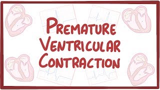 Premature Ventricular Contraction  causes symptoms diagnosis treatment pathology [upl. by Hnilym190]