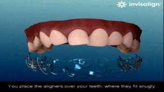 How does Invisalign work [upl. by Runkel]