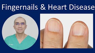 Fingernails in Heart Disease [upl. by Kassel]